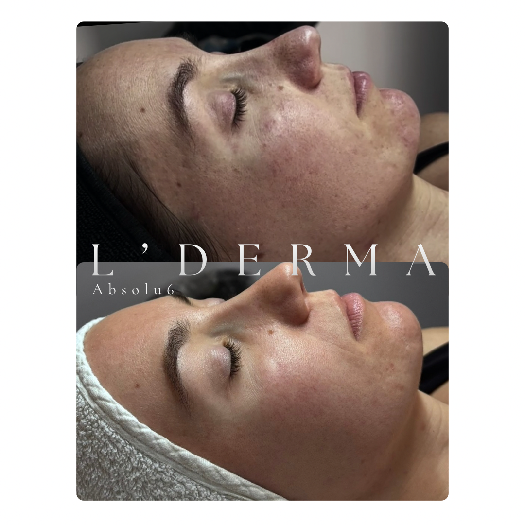 Avant / Après – L'Absolu6