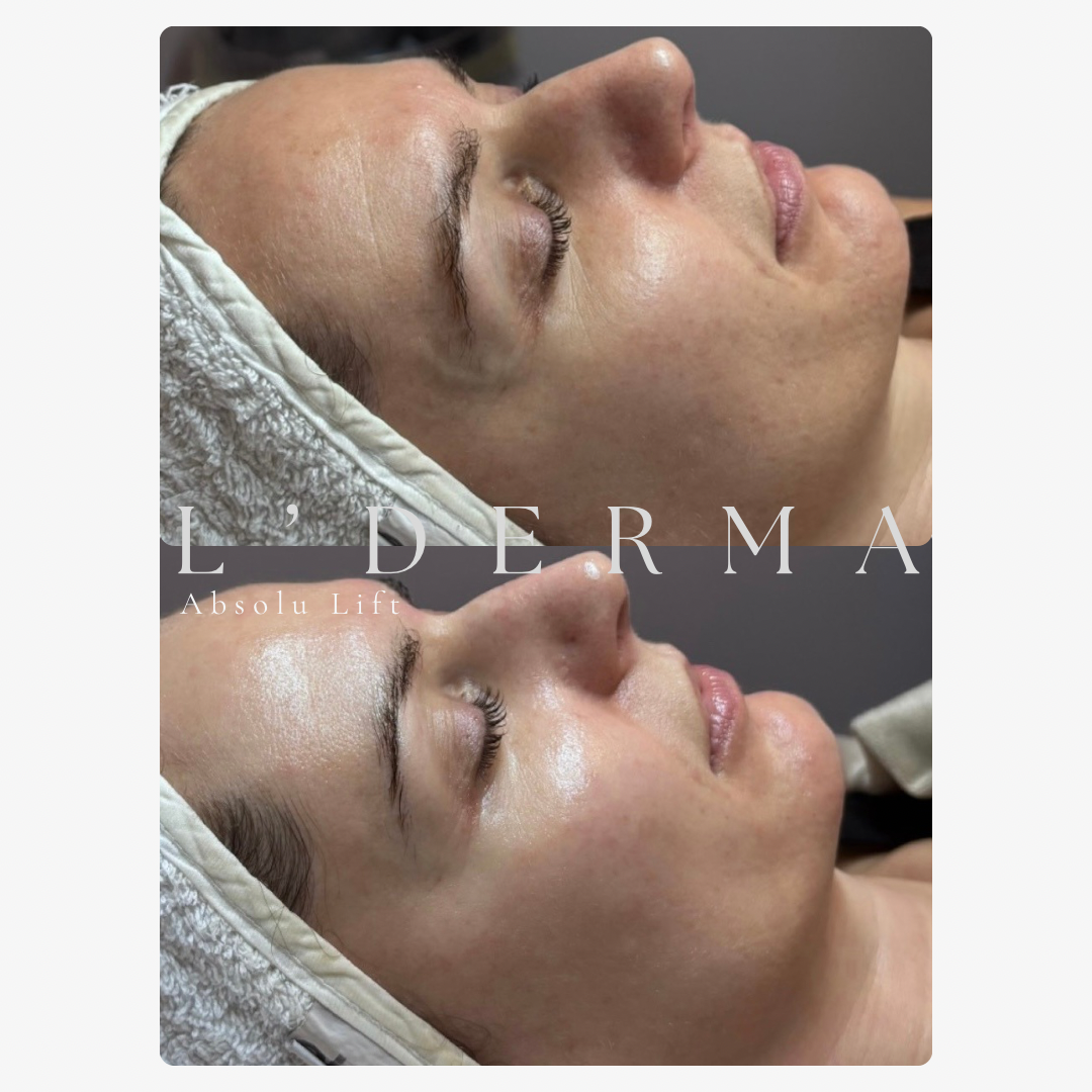 Avant / Après – L'Absolu Lift