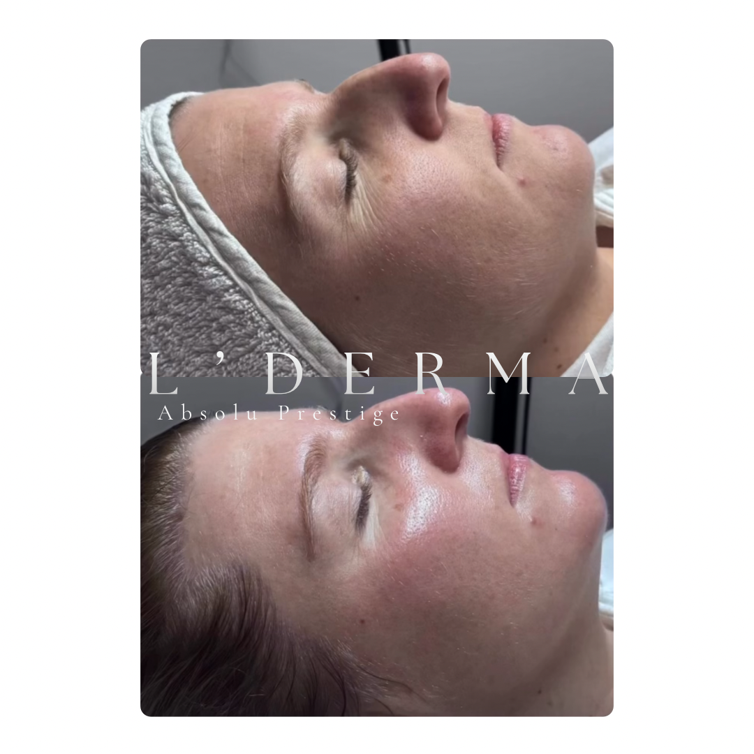 Avant / Après – L'Absolu Prestige