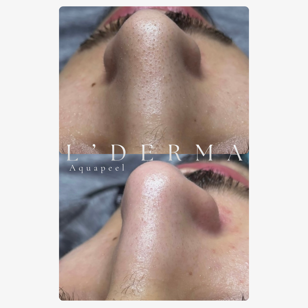 Avant / Après – Hydrodermabrasion – L'Aquapeel