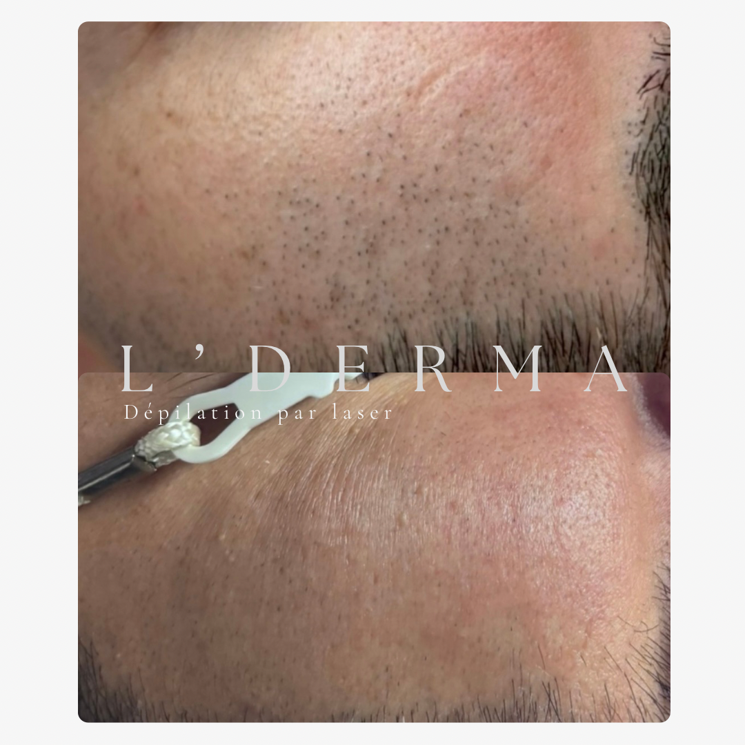 Avant / Après – Dépilation laser