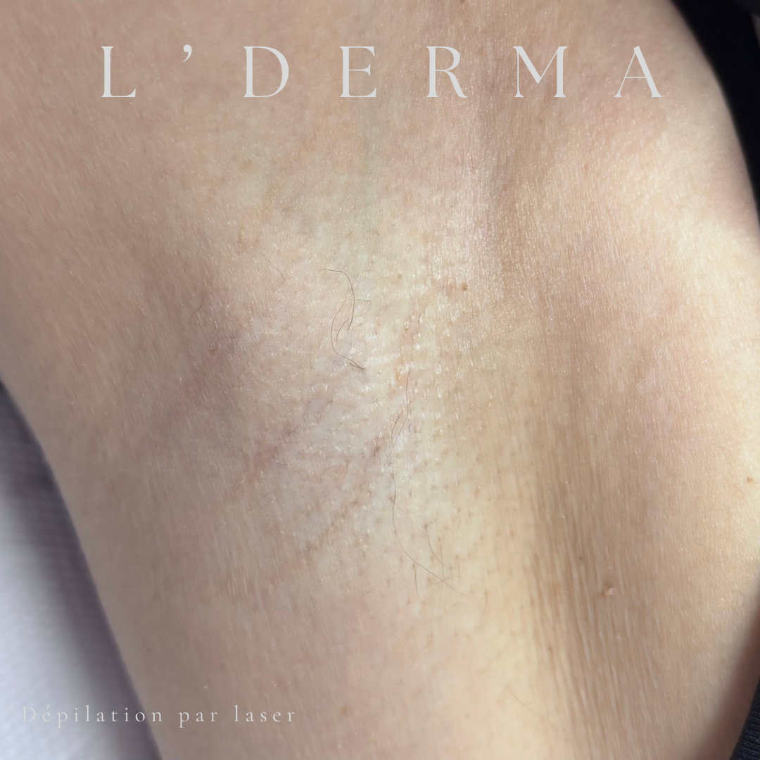 Avant / Après – Dépilation laser