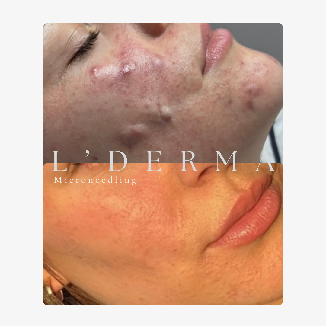 Avant / Après – Microneedling
