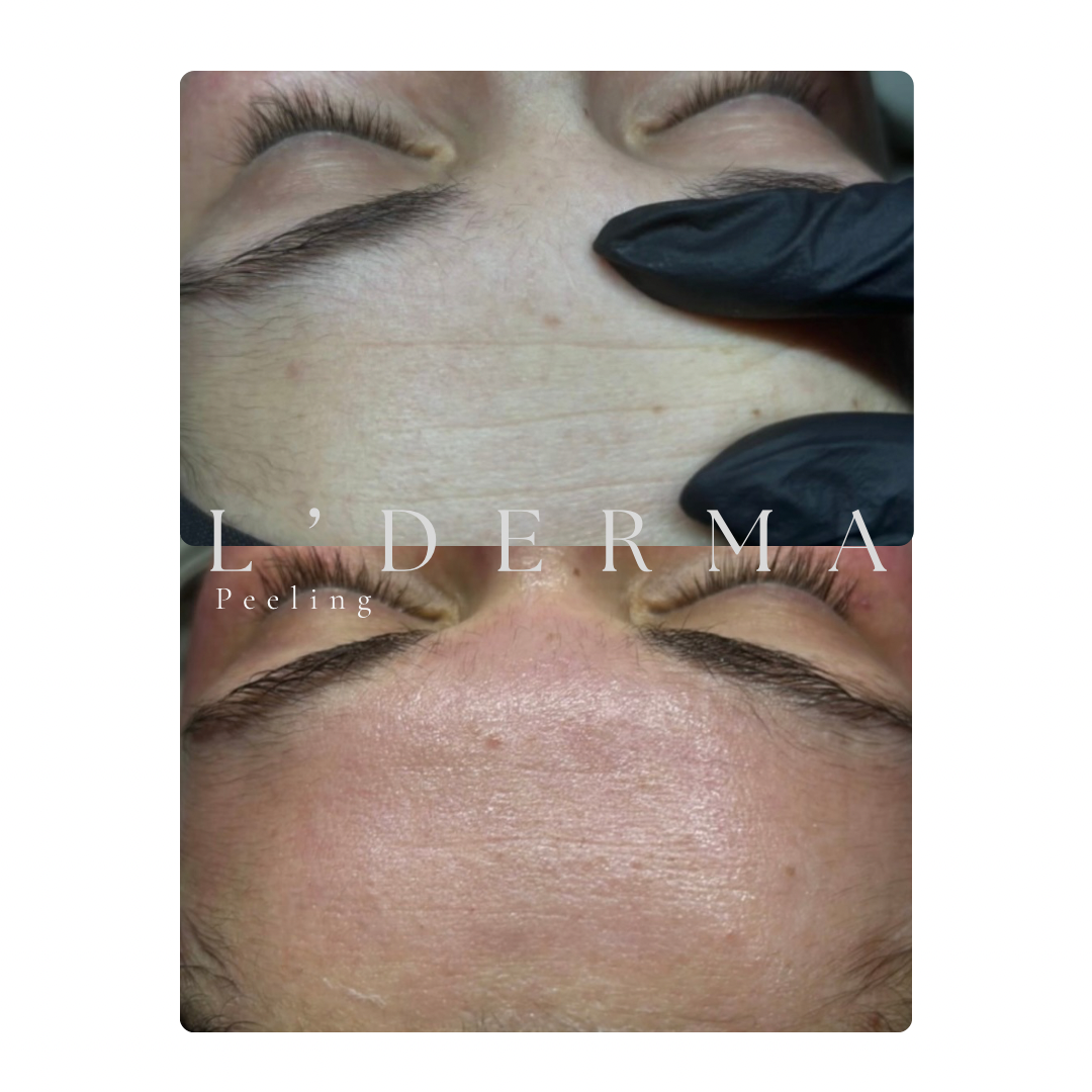 Avant / Après – Peeling aux acides de fruits