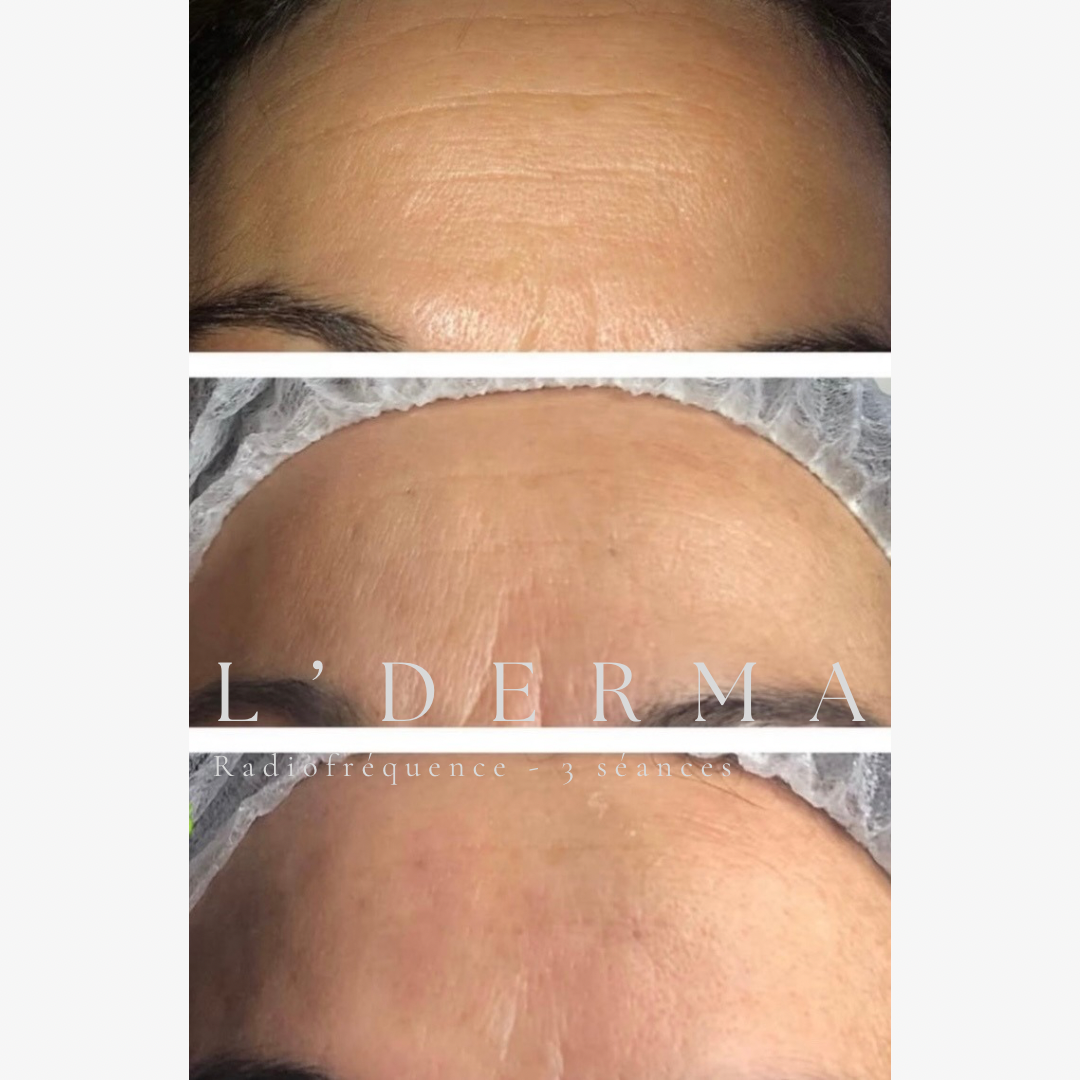 Avant / Après – Radiofréquence