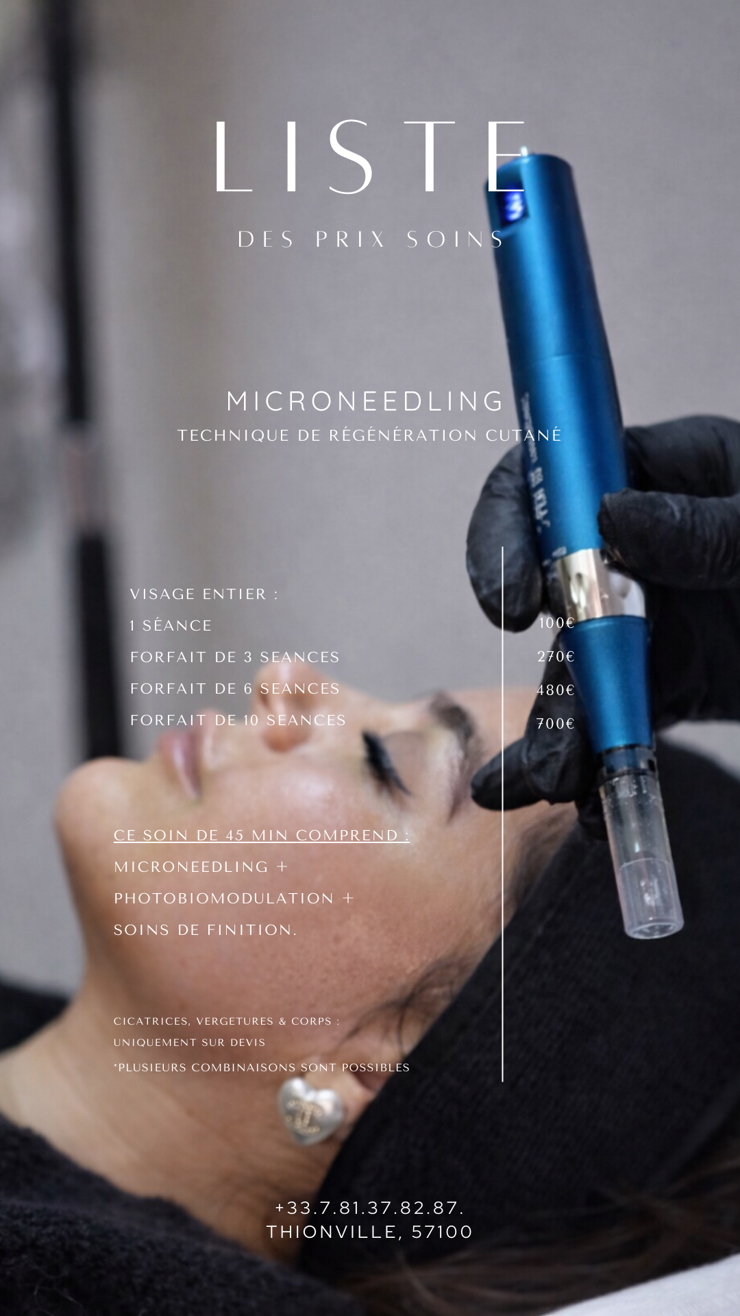 Microneedling